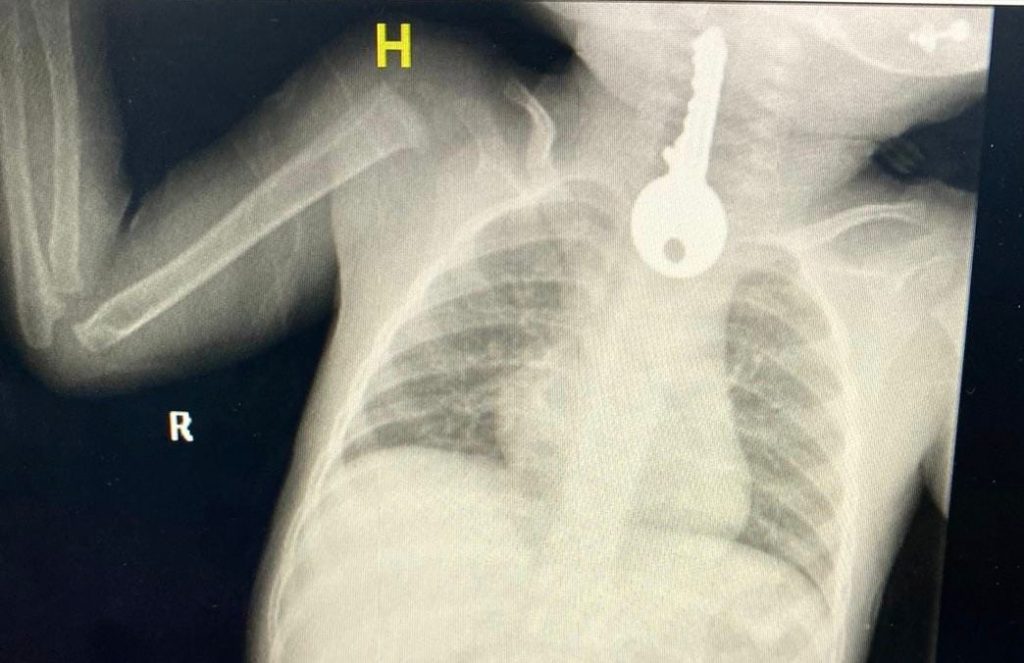 تدخل عاجل لاستخراج مفتاح من مريء طفل