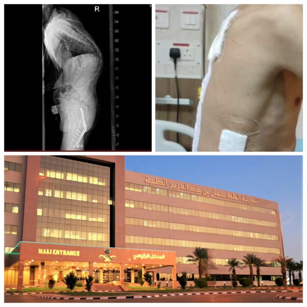 10 ساعات جراحية لإصلاح عمود فقري